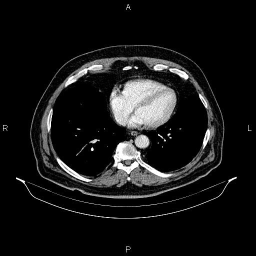 Abdominal aortic aneurysm (Radiopaedia 83094-97462 Axial renal cortical phase 52).jpg
