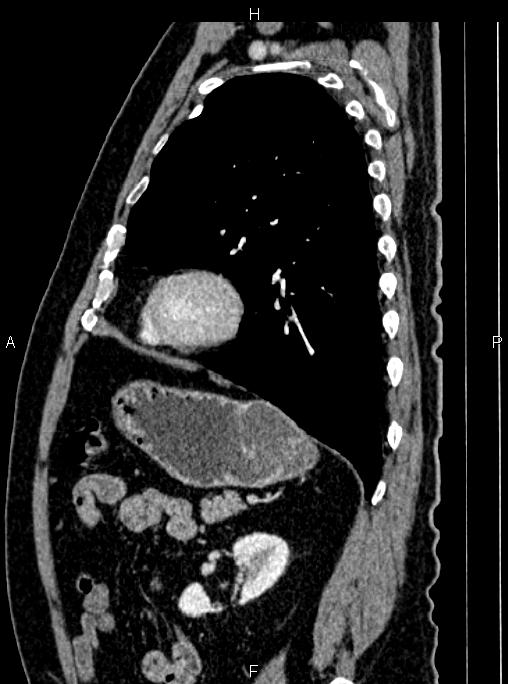 Abdominal aortic aneurysm (Radiopaedia 83094-97462 Sagittal renal cortical phase 88).jpg