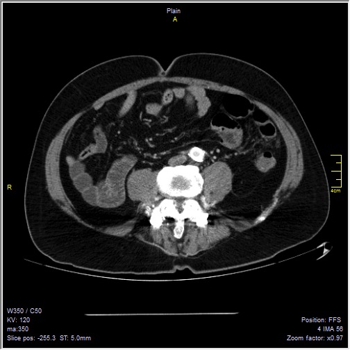 Abdominal aortic aneurysm with thrombus fissuration (Radiopaedia 47340-51926 Axial C+ arterial phase 40).jpg