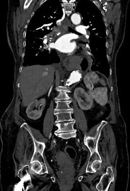 Abdominal aortic aneurysm with thrombus fissuration (Radiopaedia 73192-83919 Coronal C+ arterial phase 53).jpg