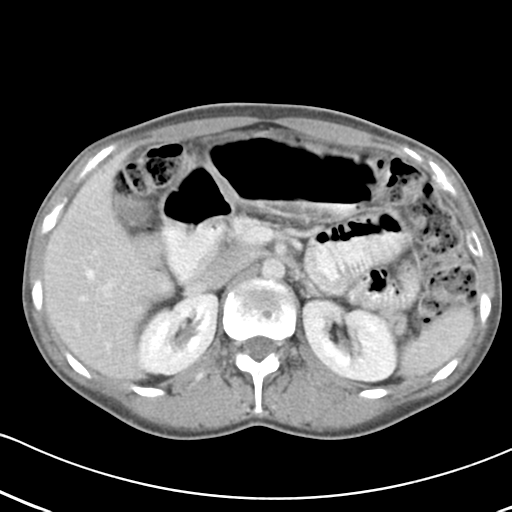 Abdominal desmoid tumor (Radiopaedia 41007-43740 Axial C+ portal venous phase 19).png