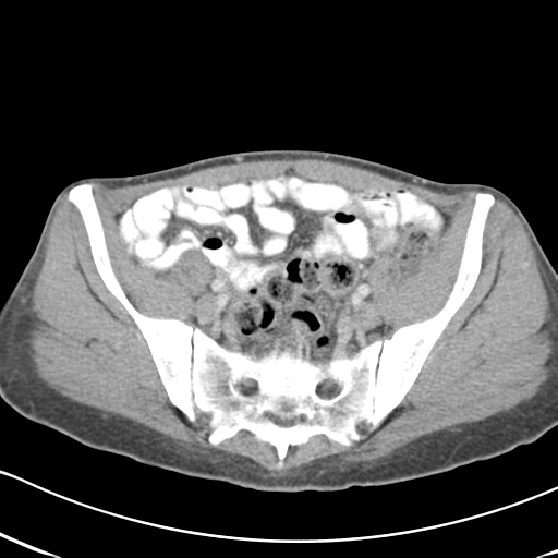File:Abdominal desmoid tumor (Radiopaedia 41007-43740 Axial C+ portal venous phase 55).png