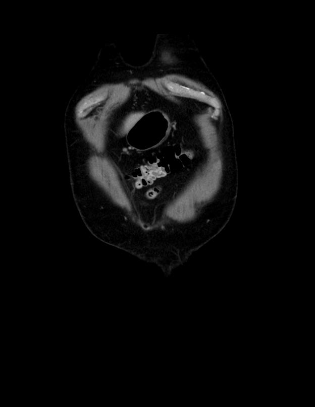 Abdominal lymphoma - with sandwich sign (Radiopaedia 53486-59492 C+ portal venous phase 55).jpg