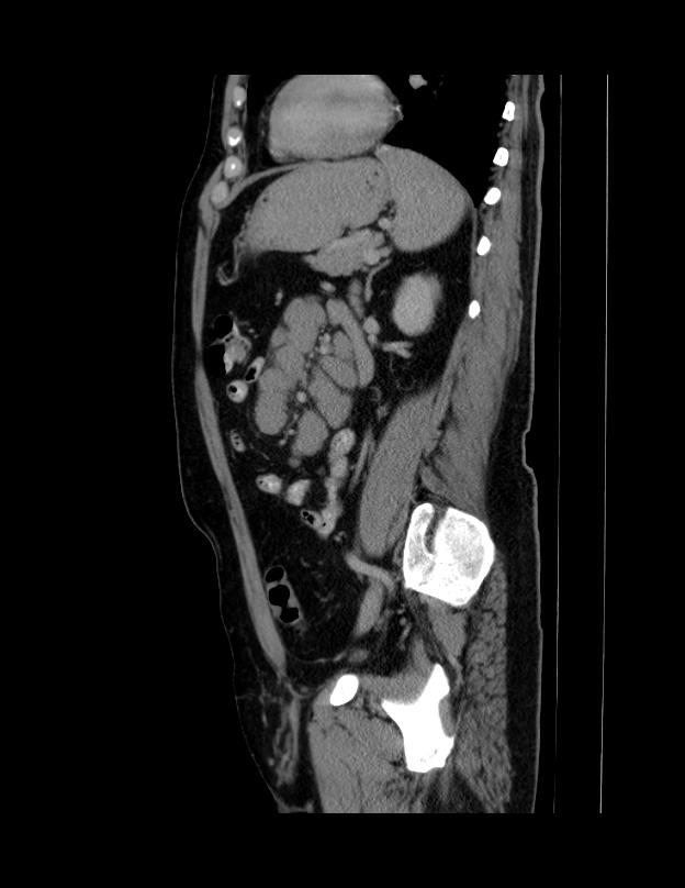Abdominal lymphoma - with sandwich sign (Radiopaedia 53486-59492 Sagittal C+ portal venous phase 27).jpg