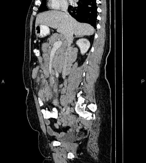 File:Abdominal lymphoma with sandwich sign (Radiopaedia 84378-99704 Sagittal C+ portal venous phase 35).jpg