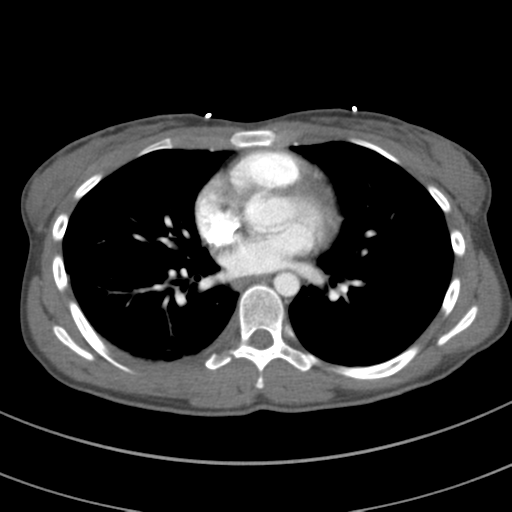 File:Abdominal multi-trauma - devascularised kidney and liver, spleen and pancreatic lacerations (Radiopaedia 34984-36486 Axial C+ arterial phase 48).png