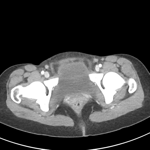 Abdominal tuberculosis and appendicitis (Radiopaedia 65631-74735 Axial C+ portal venous phase 68).png