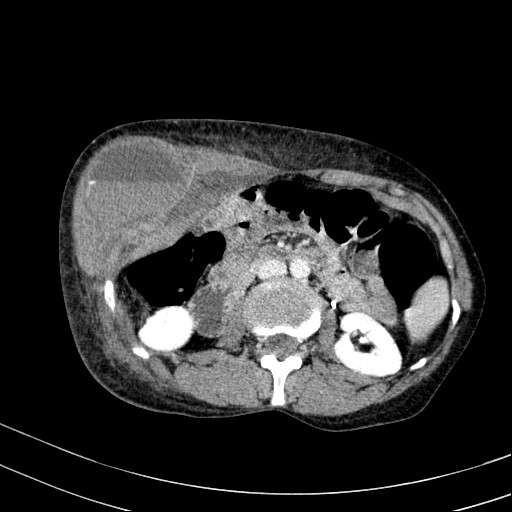 Abdominal wall hematoma with active bleeding (Radiopaedia 83915-99117 Axial C+ portal venous phase 33).jpg