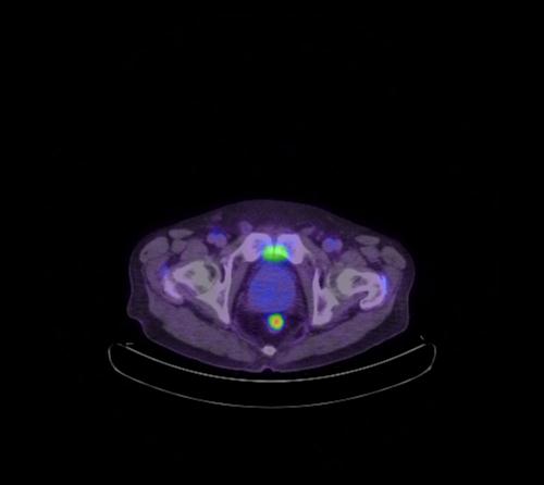 Abdominal wall metastasis from colorectal carcinoma (Radiopaedia 31016-31719 Axial 23).jpg