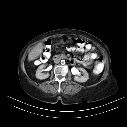 File:Abdominal wall recurrence after colorectal resection for cancer (Radiopaedia 23444-23523 Axial C+ portal venous phase 12).jpg