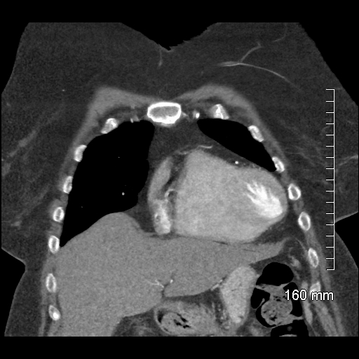 Aberrant right subclavian artery stenosis (Radiopaedia 52656-58670 B 26).jpg