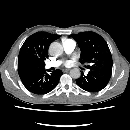 Accessory left horizontal fissure with lingular pneumonia (Radiopaedia 53763-59843 Axial C+ CTPA 48).jpg