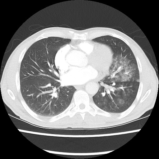 Accessory left horizontal fissure with lingular pneumonia (Radiopaedia 53763-59843 Axial lung window 34).jpg