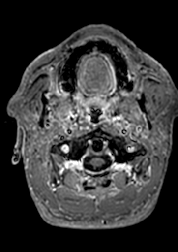 File:Accessory middle cerebral artery (Radiopaedia 73114-83828 Axial T1 C+ 215).jpg