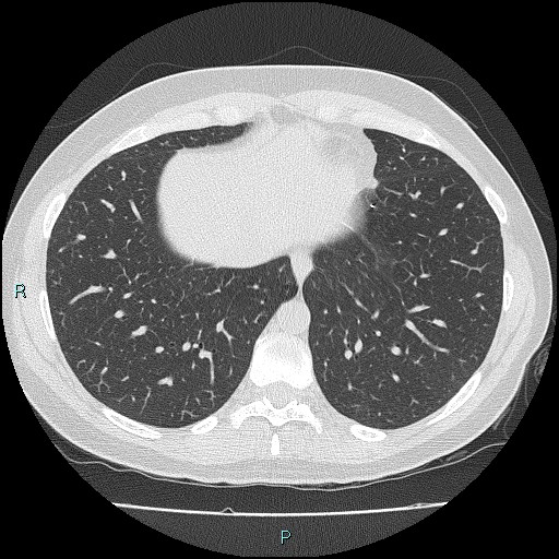 File:Accidental foreign body aspiration (seamstress needle) (Radiopaedia 77740-89983 Axial lung window 51).jpg