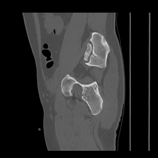 Acetabular and ilial fractures (Radiopaedia 59084-66378 Sagittal bone window 69).jpg