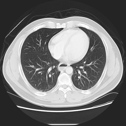 File:Achalasia (Radiopaedia 8831-9629 Axial lung window 40).jpg
