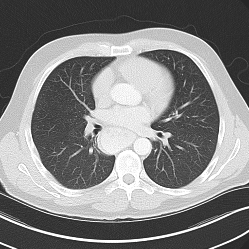 File:Achalasia of the cardia (Radiopaedia 38497-40595 Axial lung window 28).png