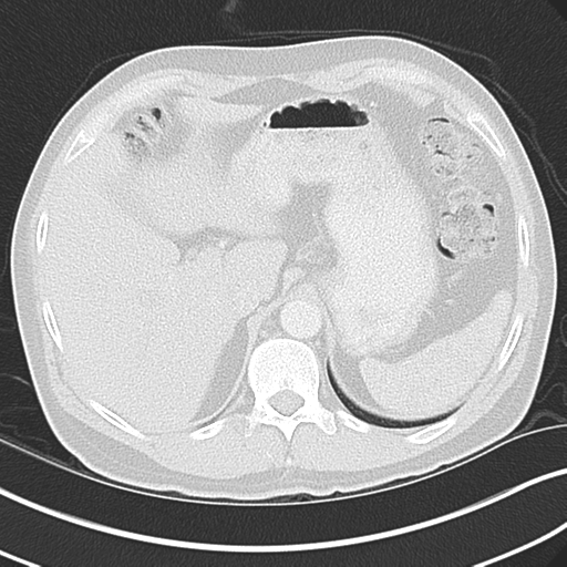 File:Achalasia of the cardia (Radiopaedia 38497-40595 Axial lung window 50).png