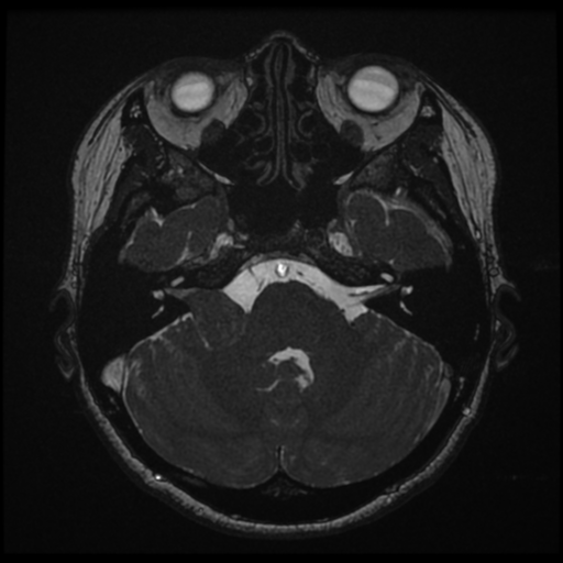 Acoustic neuroma (Radiopaedia 34049-35283 Axial 55).png