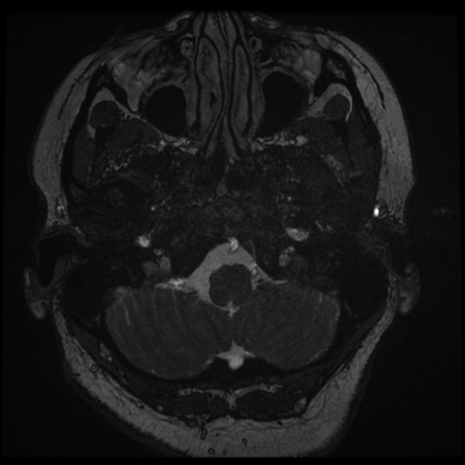 Acoustic schwannoma (Radiopaedia 57574-64536 Axial T2 1).png