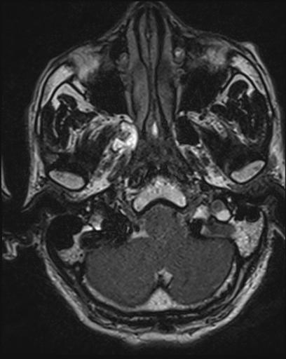 Acoustic schwannoma - probable (Radiopaedia 20386-20292 Axial T1 22).jpg