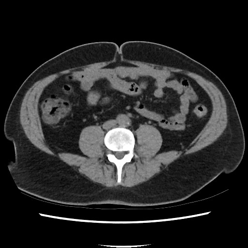 Active colonic bleed on CT (Radiopaedia 49765-55025 Axial non-contrast 49).jpg