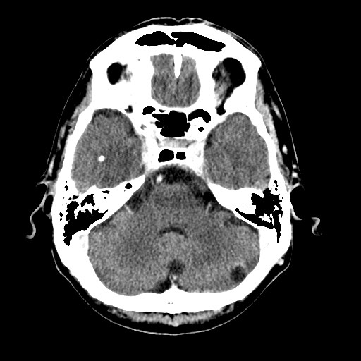File:Active neurocysticercosis before and after therapy (Radiopaedia 71710-82099 Axial C+ delayed 77).jpg