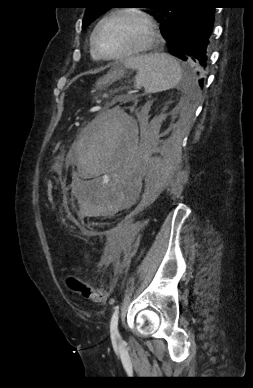Active renal extravasation with large subcapsular and retroperitoneal hemorrhage (Radiopaedia 60975-68796 Sagittal C+ portal venous phase 76).jpg
