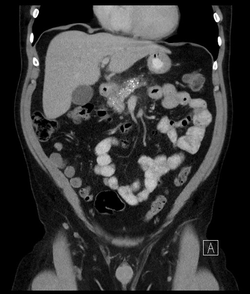 Acute-on-chronic pancreatitis (Radiopaedia 67286-76656 Coronal C+ portal venous phase 32).jpg