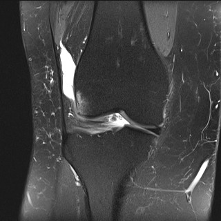 File:Acute-on-chronic transient lateral patellar dislocation with trochlear dysplasia (Radiopaedia 84099-99349 Coronal PD fat sat 24).jpg