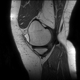 File:Acute-on-chronic transient lateral patellar dislocation with trochlear dysplasia (Radiopaedia 84099-99349 Sagittal PD 41).jpg