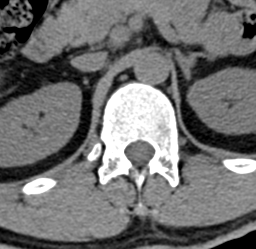 File:Acute L1 burst compression fracture (Radiopaedia 34430-35755 Axial non-contrast 10).png