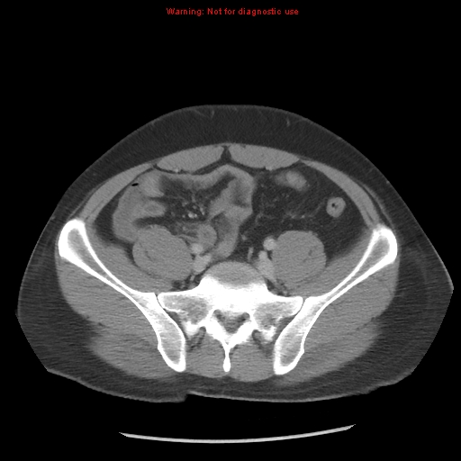 Acute appendicitis (Radiopaedia 10498-10973 Axial C+ portal venous phase 28).jpg