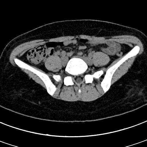 Acute appendicitis (Radiopaedia 30261-30888 Axial non-contrast 64).jpg