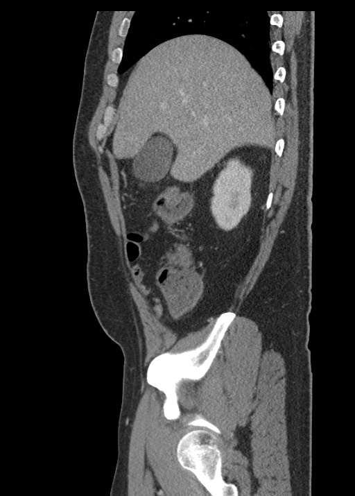 Acute appendicitis (Radiopaedia 48511-53463 Sagittal C+ portal venous phase 38).jpg