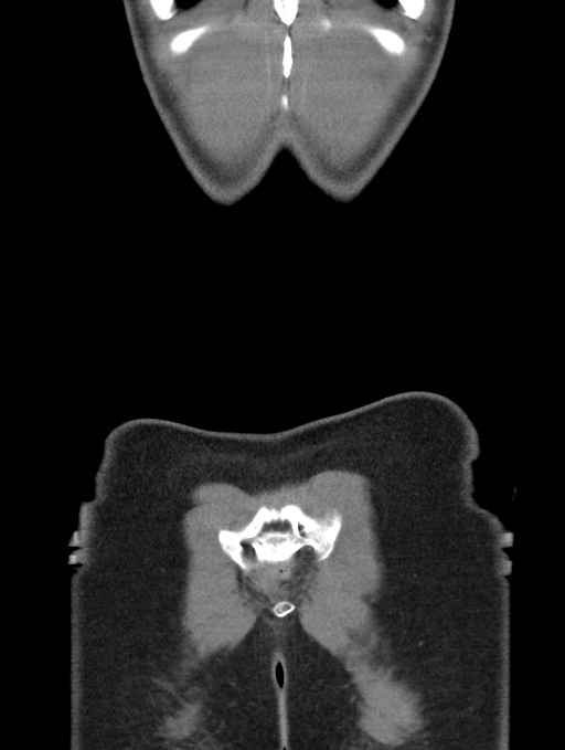 Acute appendicitis (Radiopaedia 62608-70901 Coronal C+ portal venous phase 63).jpg