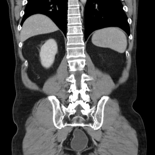 Acute appendicitis (Radiopaedia 66513-75790 Coronal C+ portal venous phase 68).jpg