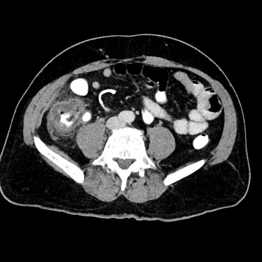 Acute appendicitis (Radiopaedia 77016-88960 Axial C+ portal venous phase 91).jpg
