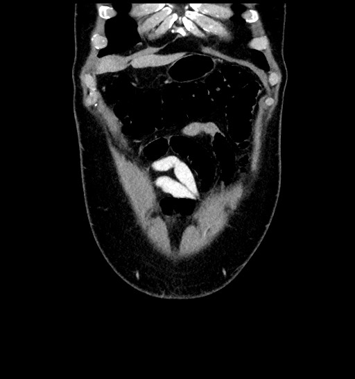 Acute appendicitis (Radiopaedia 77016-88960 Coronal C+ portal venous phase 22).jpg