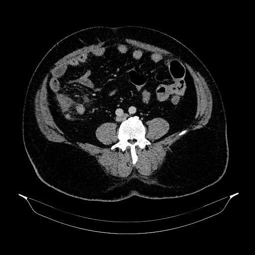 File:Acute appendicitis (Radiopaedia 79950-93224 Axial C+ portal venous phase 65).jpg
