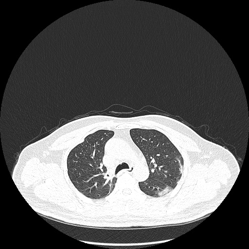 File:Acute appendicitis and COVID 19 pneumonia (Radiopaedia 76604-88380 Axial lung window 19).jpg
