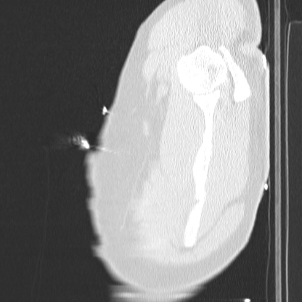 Acute aspiration pneumonitis (Radiopaedia 33605-34703 Sagittal lung window 86).jpg