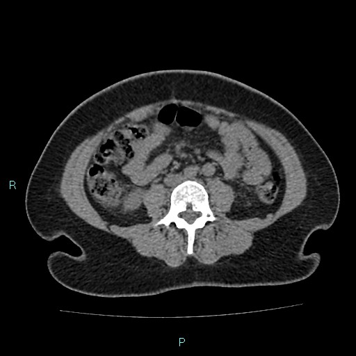 Acute bilateral pyelonephritis (Radiopaedia 37146-38881 Axial non-contrast 60).jpg