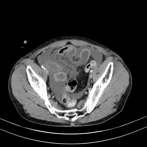 Acute bowel ischemia (Radiopaedia 87695-104114 Axial C+ portal venous phase 72).jpg