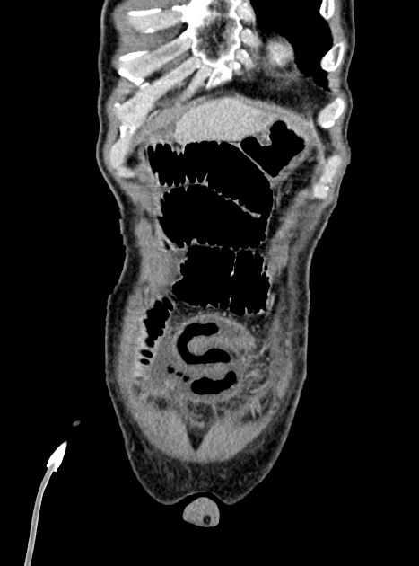 Acute bowel ischemia (Radiopaedia 87695-104114 Coronal C+ portal venous phase 89).jpg