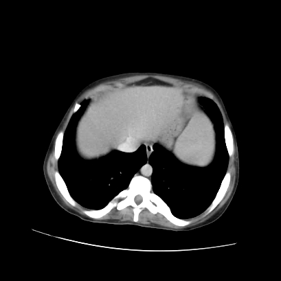 Acute calculous cholecystitis in patient with osteopetrosis (Radiopaedia 77871-90159 Axial C+ portal venous phase 17).jpg