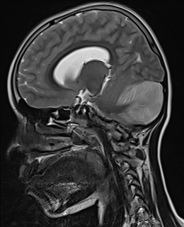 File:Acute cerebellar ataxia (Radiopaedia 61487-69446 Sagittal T2 8).jpg