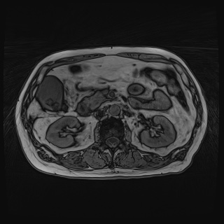 Acute cholecystitis (Radiopaedia 72392-82923 Axial T1 out-of-phase 63).jpg