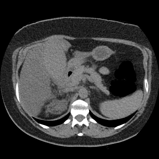 Acute cholecystitis and ureteric colic (Radiopaedia 42330-45444 Axial prone 25).jpg